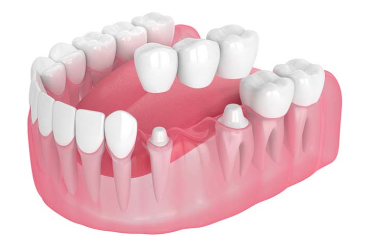 Dental Implants