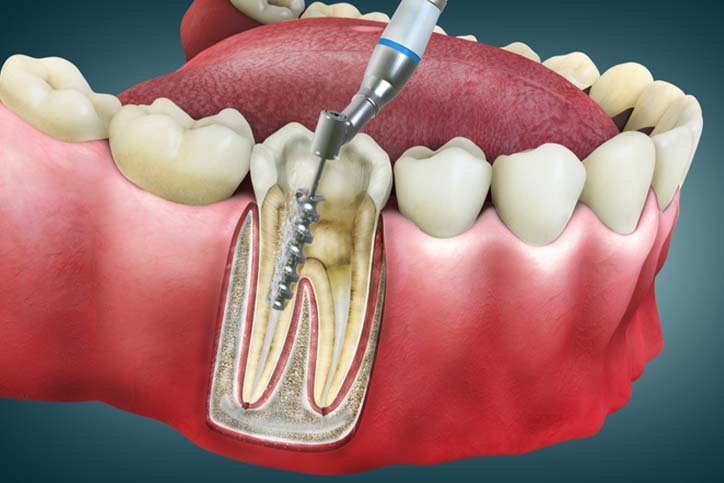 Root canal