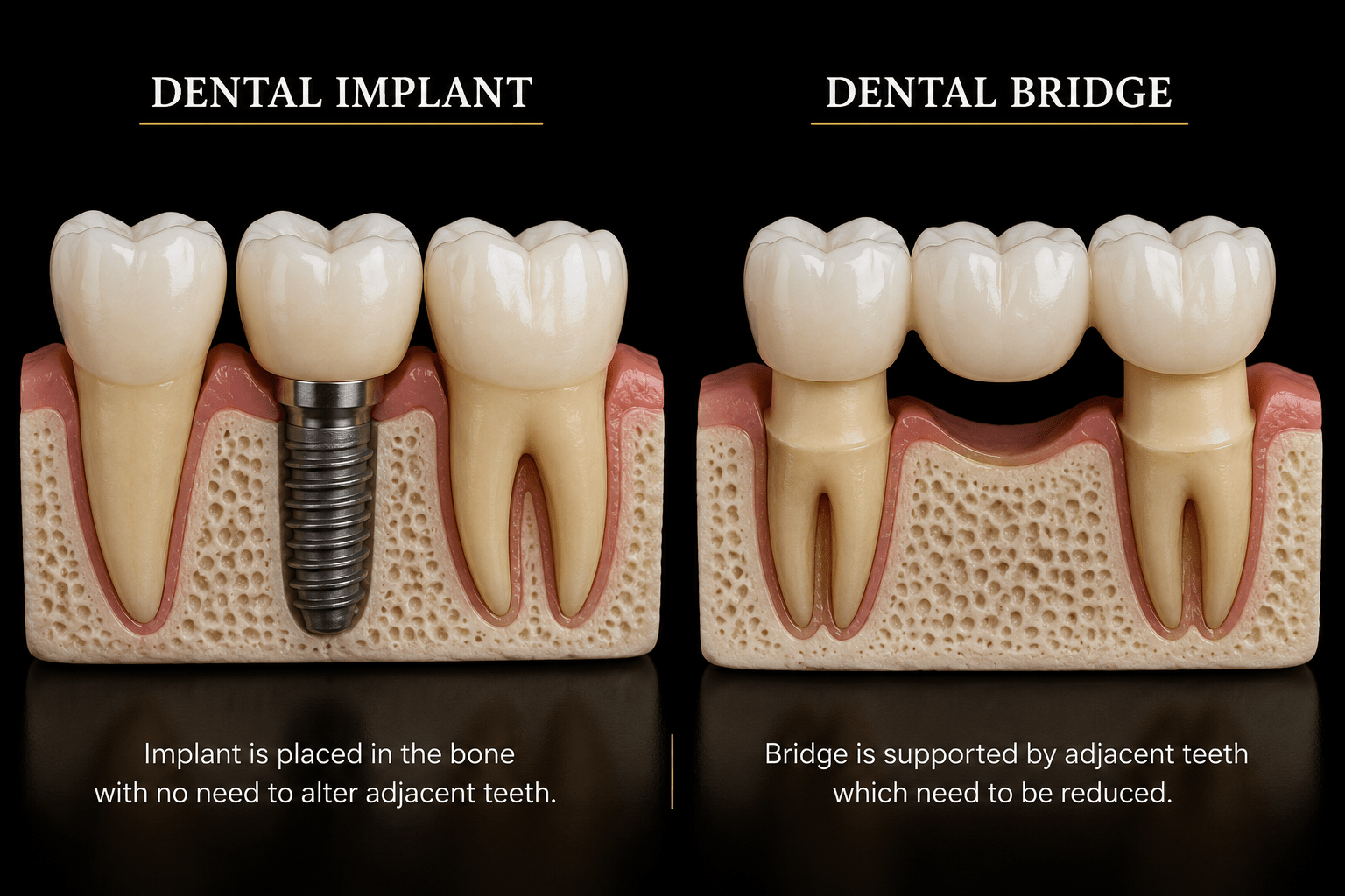 Dental implant versus dental bridge comparison