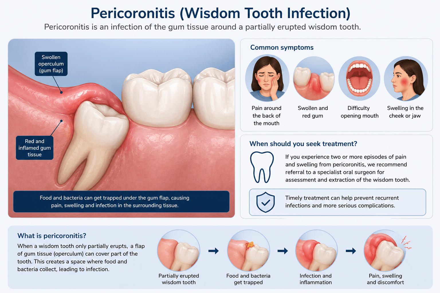 Diagram of pericoronitis — inflammation around a partially erupted wisdom tooth
